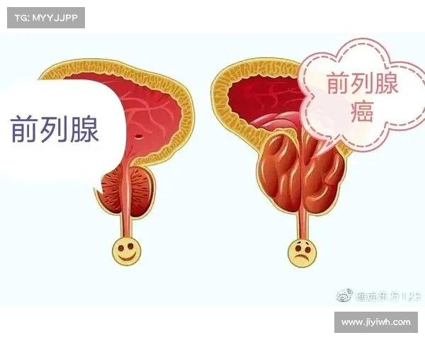 莫宁前列腺癌切除手术顺利完成,医生确认癌症未扩散(前列腺癌早期切除后能活多久) 莫宁前列腺癌切除手术顺利完成,医生确认癌症未扩散(前列腺癌早期切除后能活多久)